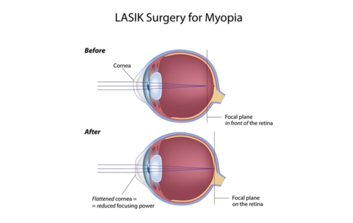 Cross section diagrams showing before and after of the eye, with the bottom image showing a flattened cornea and focal plane landing correctly on the retina.