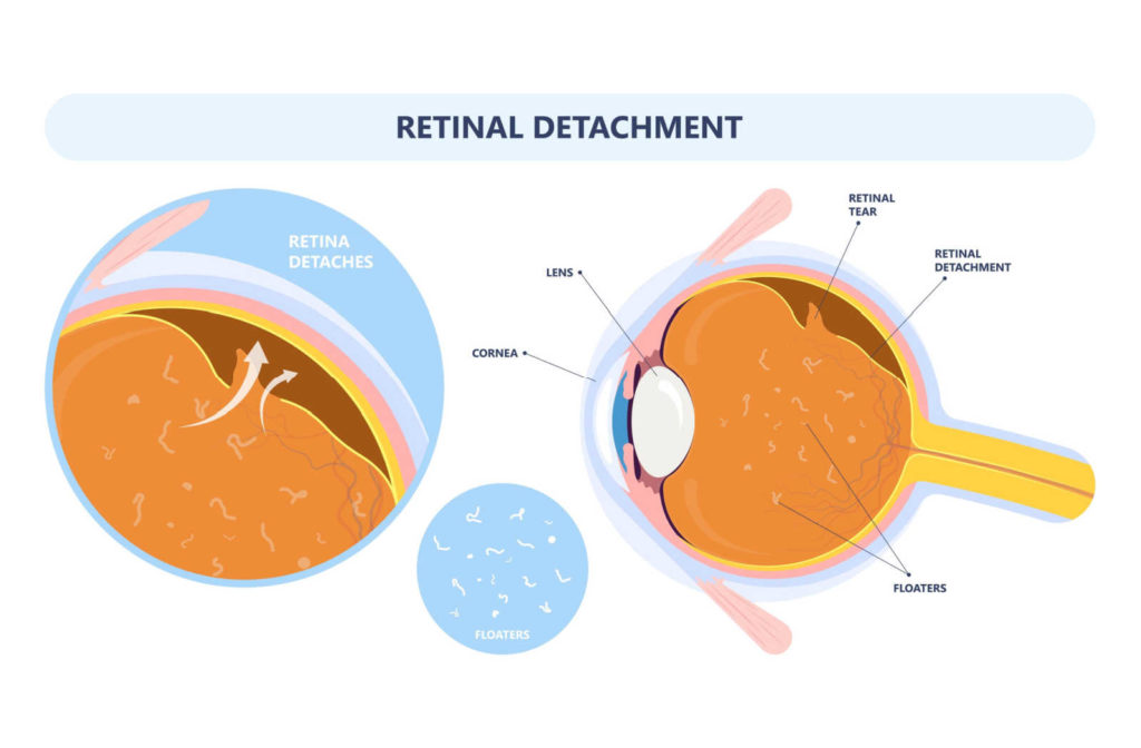 Drawn image showing a cross section of an eye with a close up of the detached retina section.
