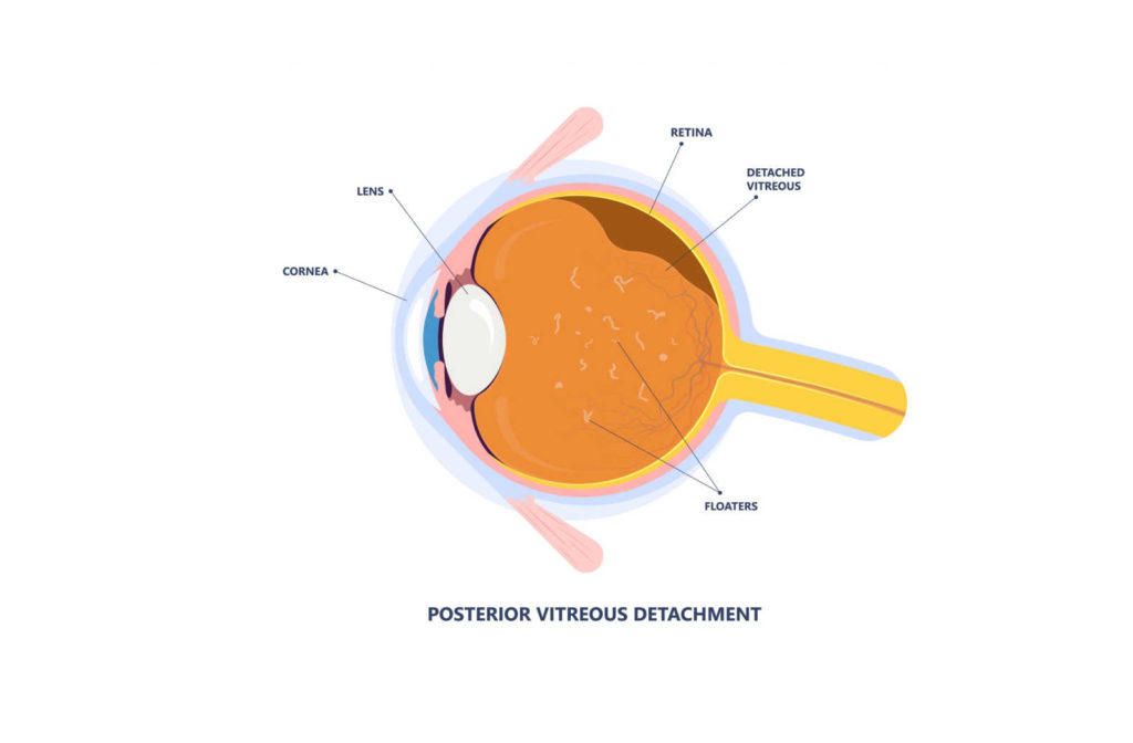 Graphical ross section of an eye showing vitreous detachment.