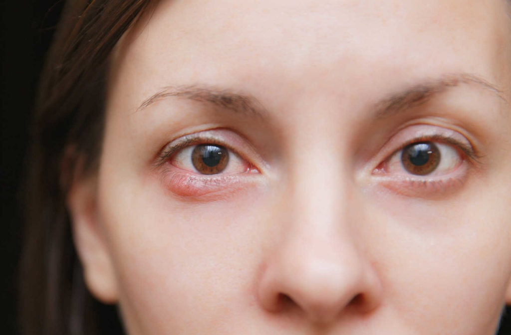 A close-up eyes of a young woman with an inflamed stye.