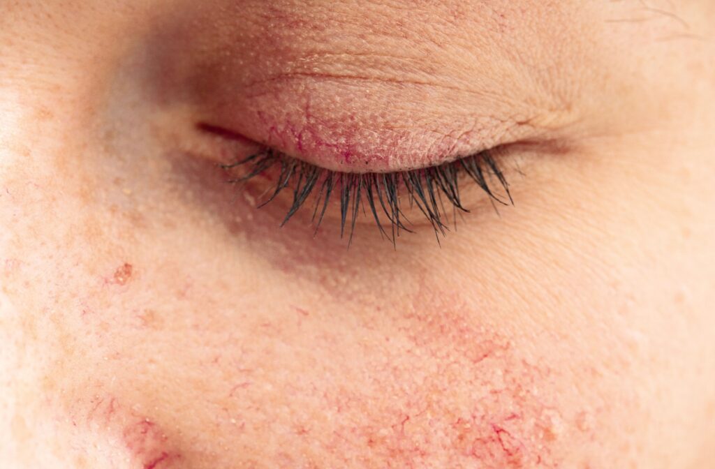 Close-up of closed eye with red rosacea around eye and face.