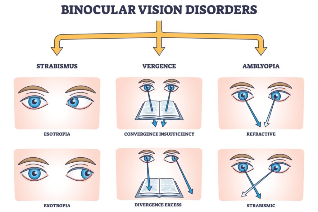 Diagram showing types of binocular vision disorders, including strabismus (esotropia and exotropia), vergence issues (convergence insufficiency and divergence excess), and amblyopia (refractive and strabismic).