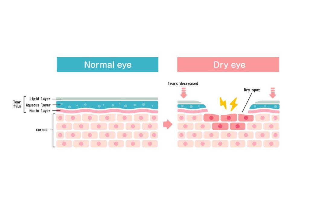 Illustration comparing a normal eye with a dry eye, showing the tear film layers (lipid, aqueous, mucin) and how tear reduction causes dry spots on the cornea.