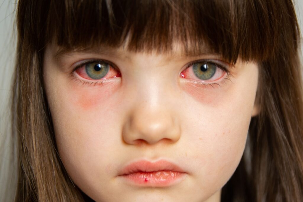 Close-up of a child's face showing red, irritated eyes with visible inflammation characteristic of conjunctivitis or pink eye.